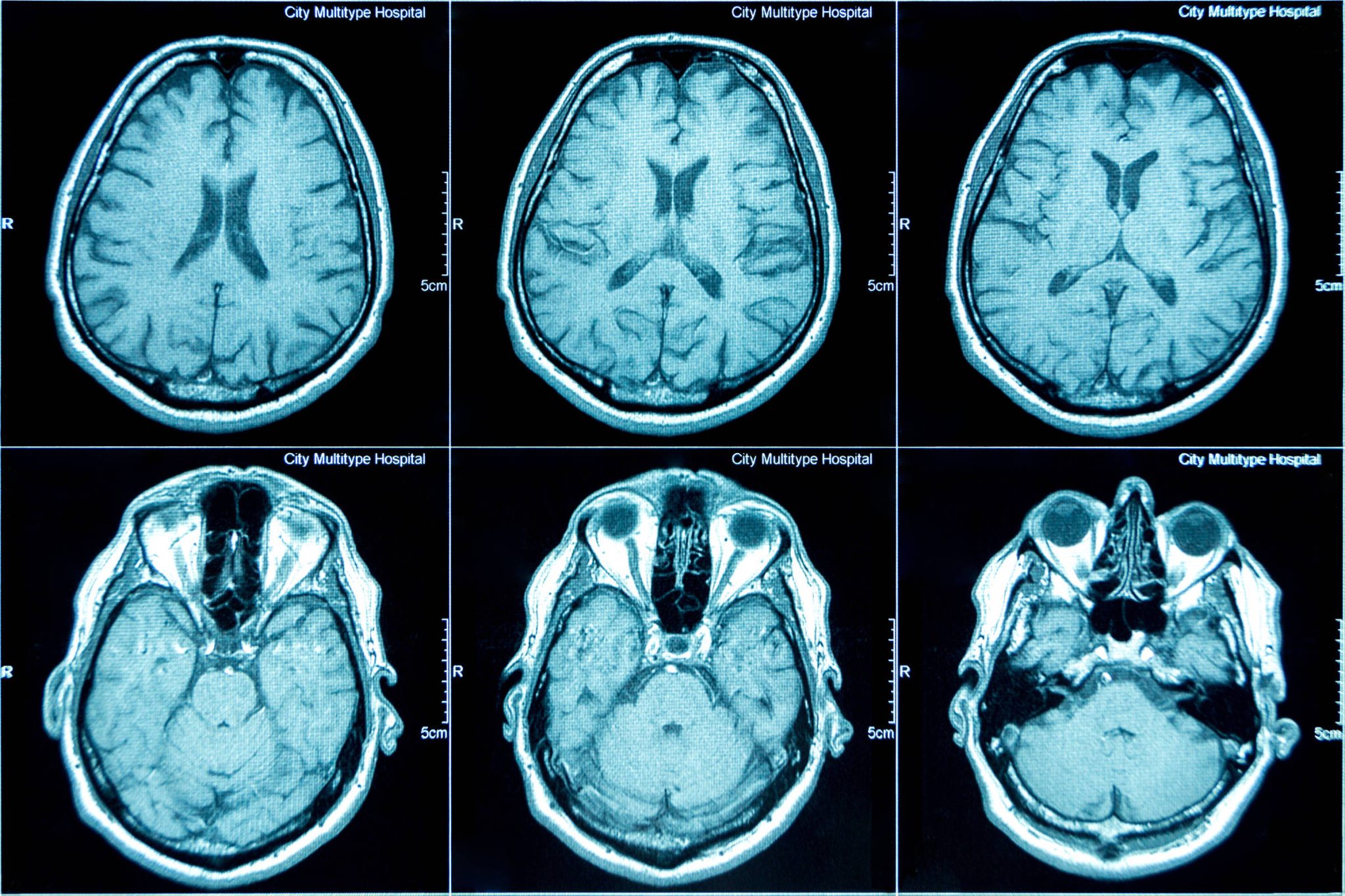 uniao-europeia-aprova-tratamento-pioneiro-contra-o-alzheimer