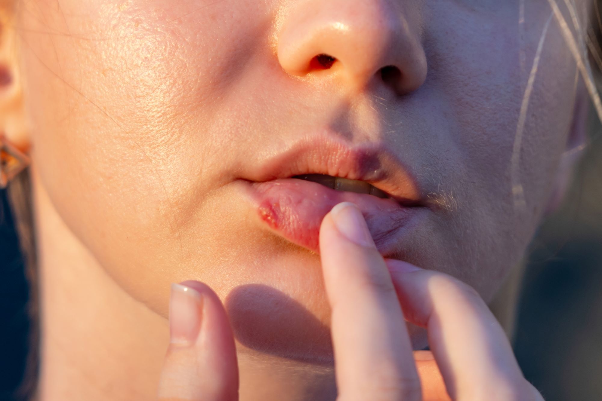 virus-do-herpes-pode-ter-ligacao-com-desenvolvimento-de-alzheimer