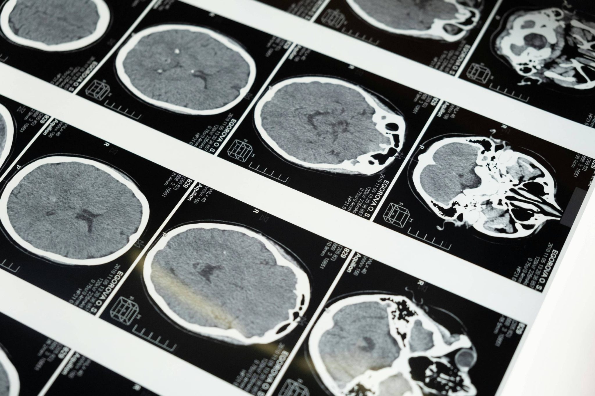 entenda-o-que-e-o-donanemabe,-o-medicamento-aprovado-para-tratamento-de-alzheimer-no-brasil