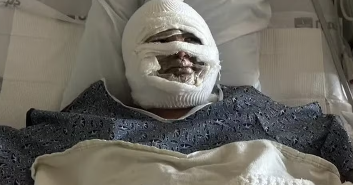 jovem-sofre-queimaduras-no-rosto-apos-lareira-a-alcool-explodir-durante-acampamento