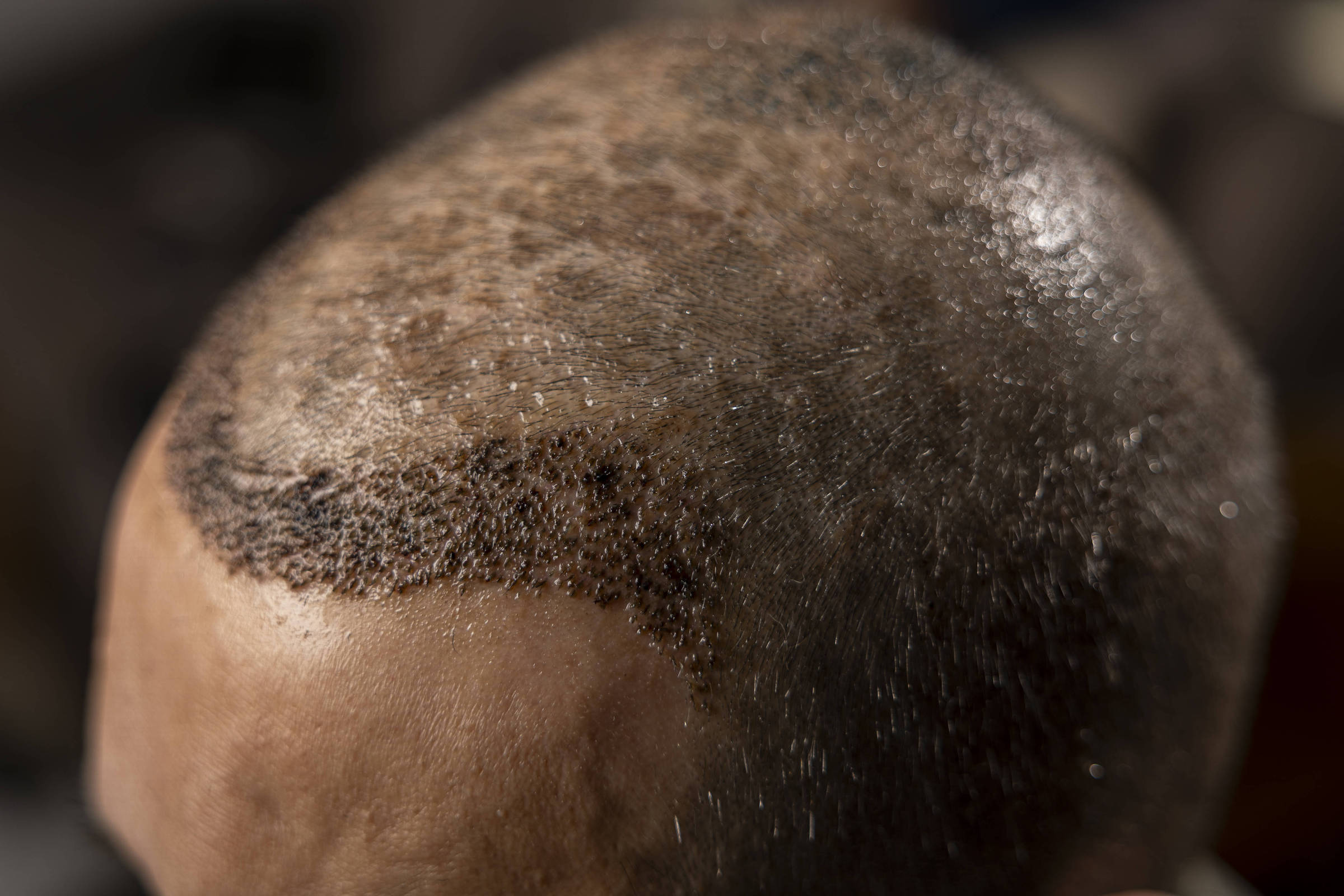 pos-operatorio-de-transplante-capilar-inclui-camara-hiperbarica-e-gastos-extras-de-r$-4.000