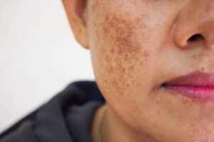ciencia-mostra-como-a-dieta-ajuda-a-prevenir-e-a-tratar-o-melasma