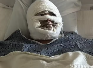 jovem-sofre-queimaduras-no-rosto-apos-lareira-a-alcool-explodir-durante-acampamento