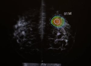mamografia-com-ia-melhora-diagnostico-de-cancer,-mostra-estudo