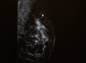 com-ia,-mamografia-pode-ajudar-a-avaliar-risco-cardiaco-em-mulheres